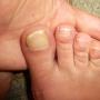 Жёлтые ногти на ногах — какие причины и лечение